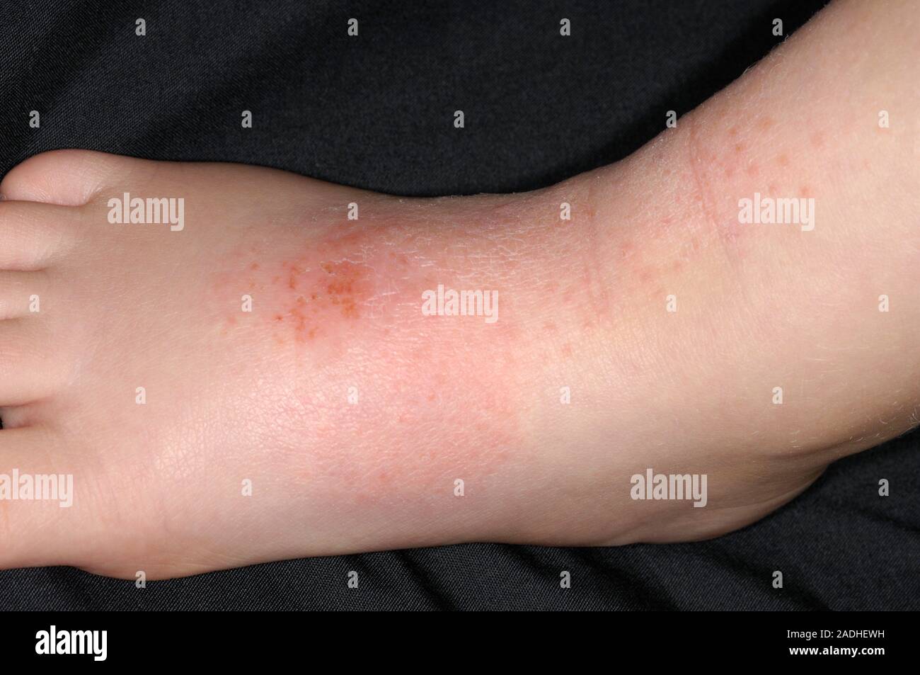 Atopic eczema affecting the skin on a 2yearold boy's foot. Atopic