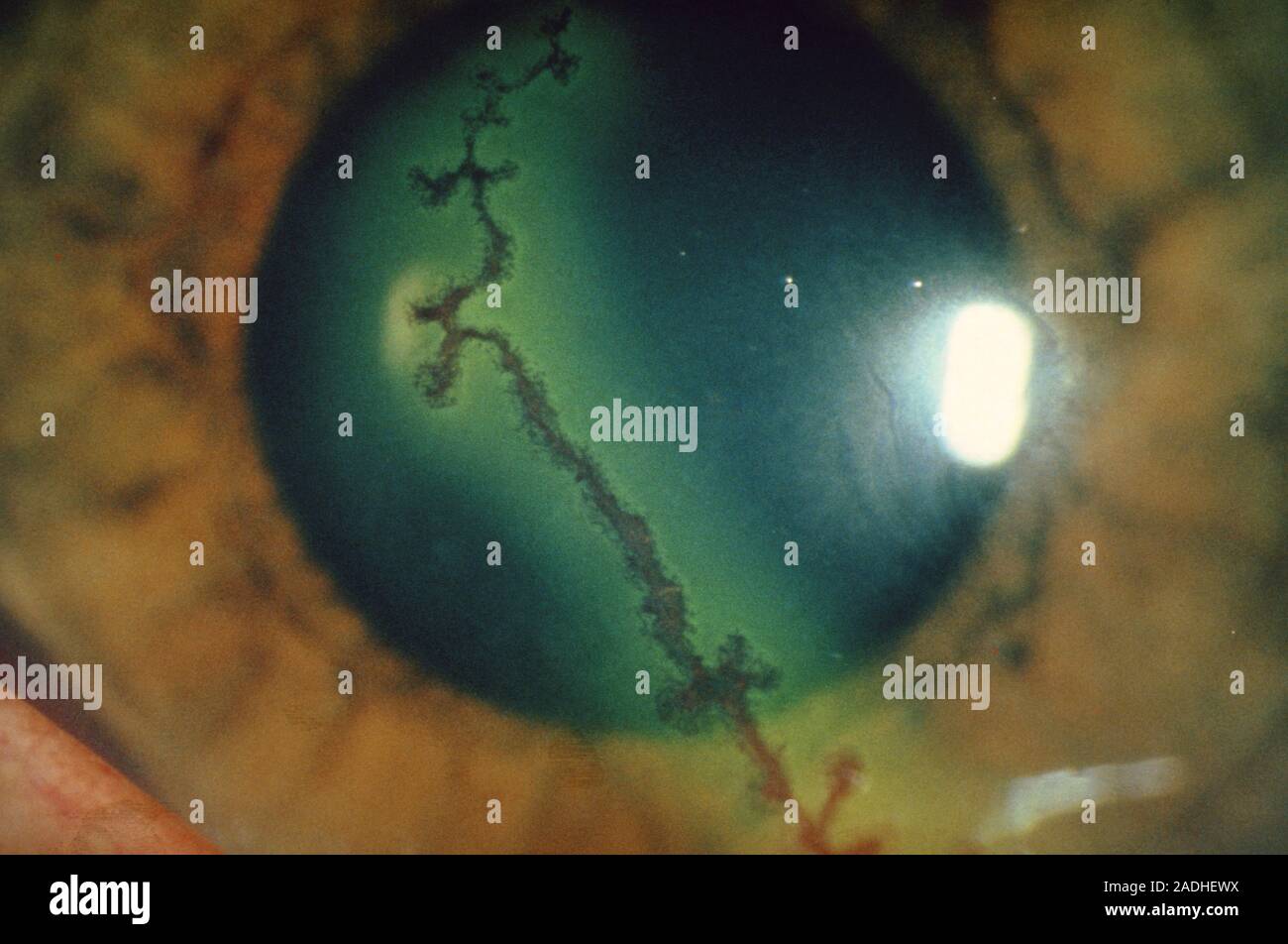 Slitlamp photograph of the cornea of an eye affected with a dendritic