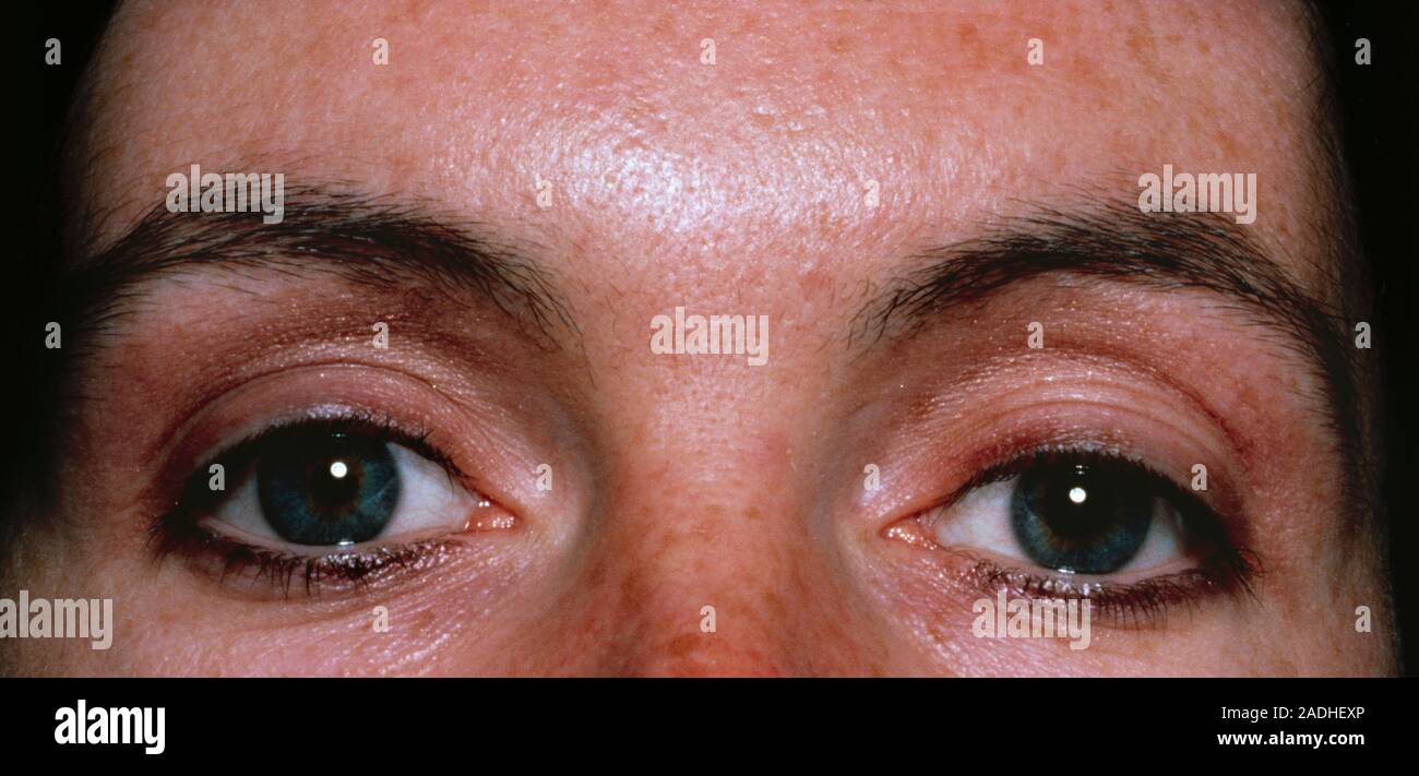 Pupil dilated. Closeup of the eyes of a woman with one normal pupil