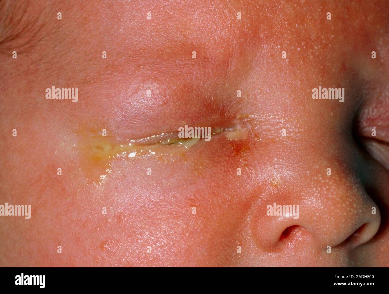 Newborn baby with sticky eye" or neonatal conjunctivitis. Conjunctivitis is an inflammation of