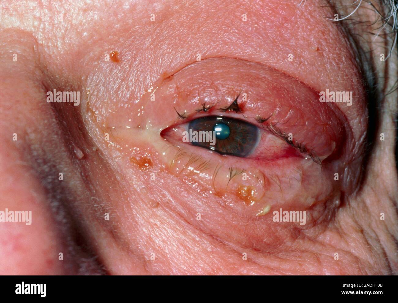 Conjunctivitis. Closeup of the left eye of a patient suffering from
