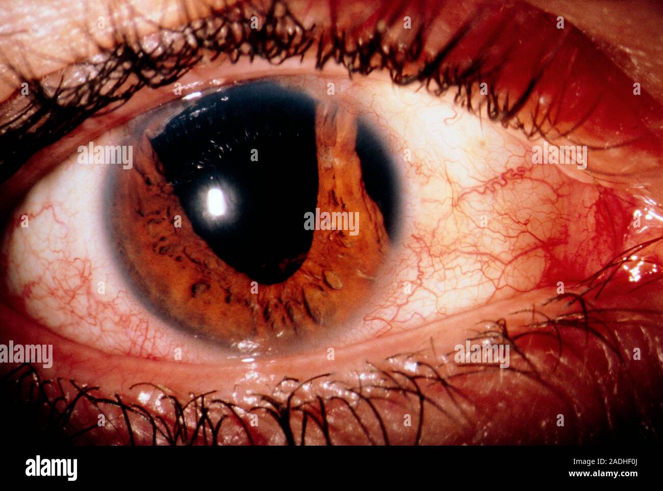 Closeup of a sore, inflamed eye in acute with an irregularly