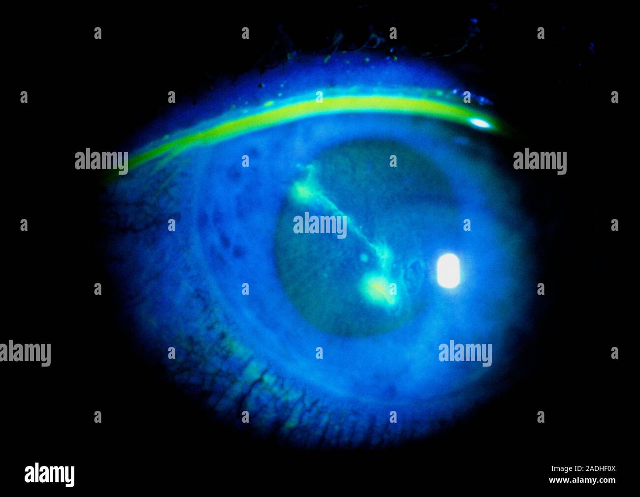 Healing Abrasion To The Cornea Of The Eye Revealed Under Ultraviolet