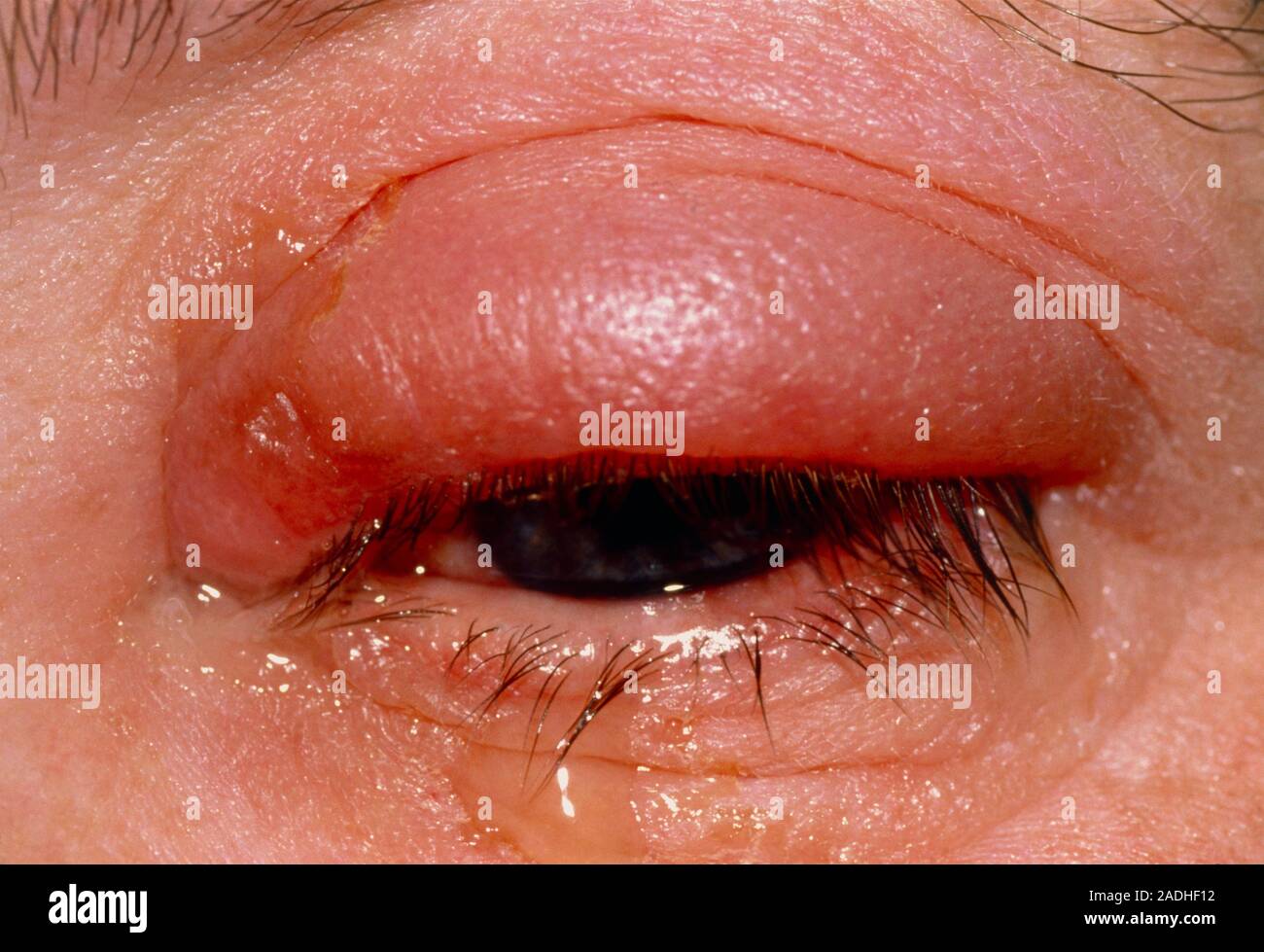 Conjunctivitis. Closeup of the left eye of a patient suffering from
