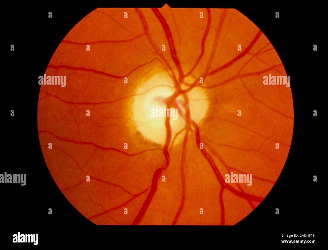 Optic atrophy. Ophthalmoscope view of the retina of the eye in a