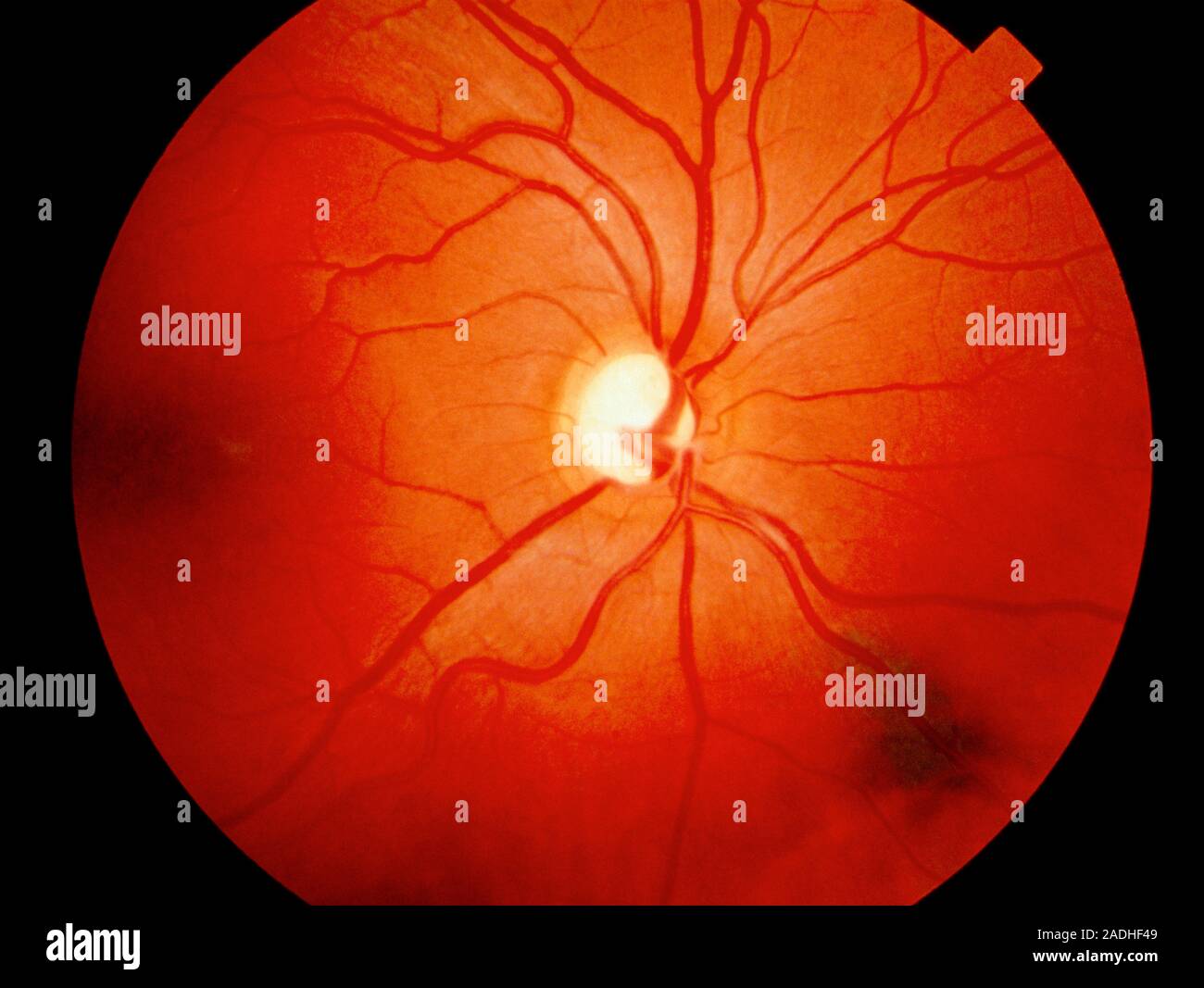 disc cupping. Ophthalmoscope view of disccupping seen on the