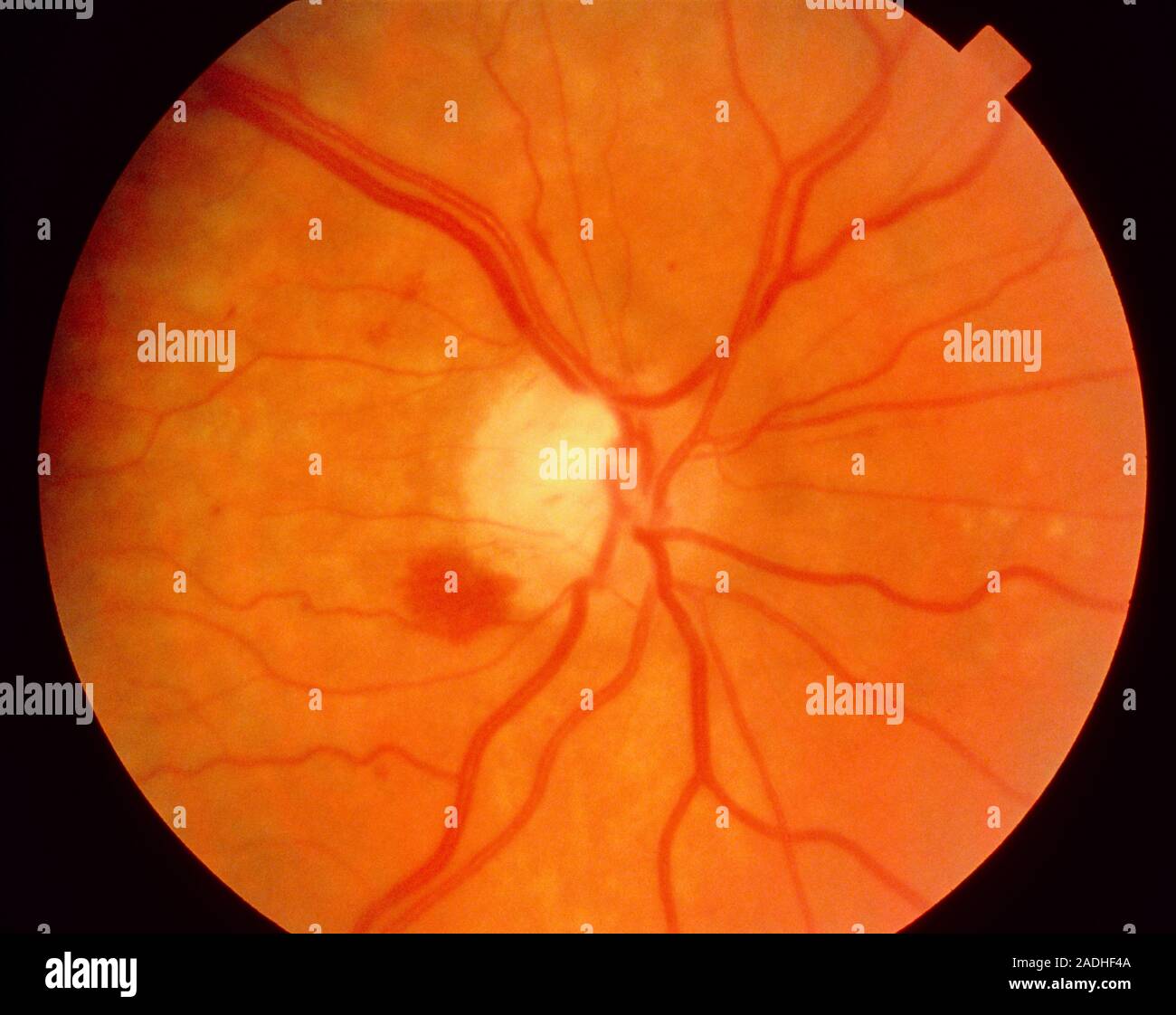 Ophthalmoscope view of the retina of a patient's eye with
