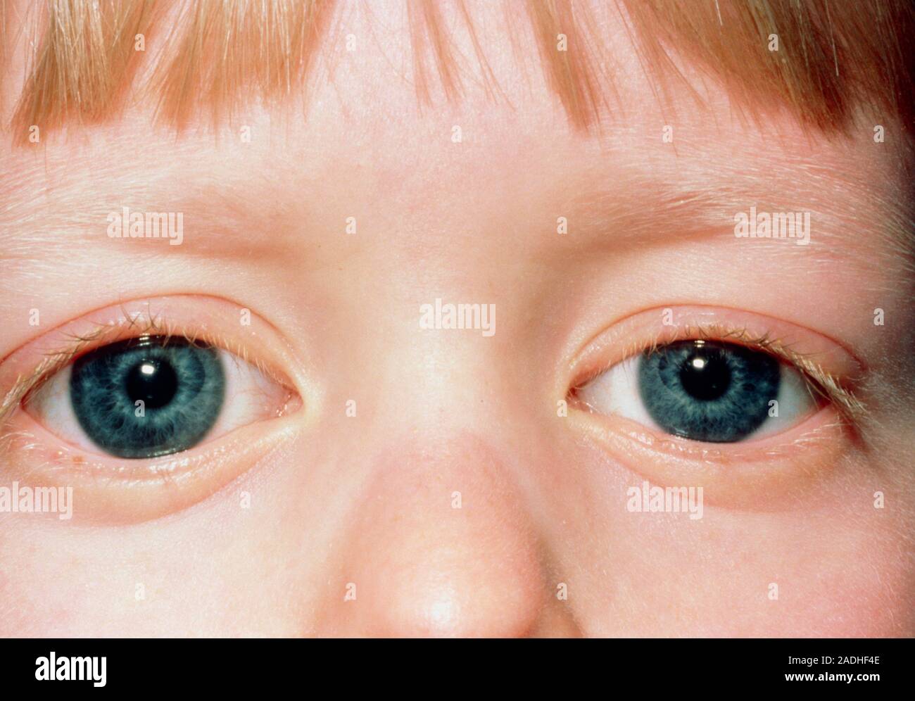 Congenital Closeup of the eyes of a child suffering from