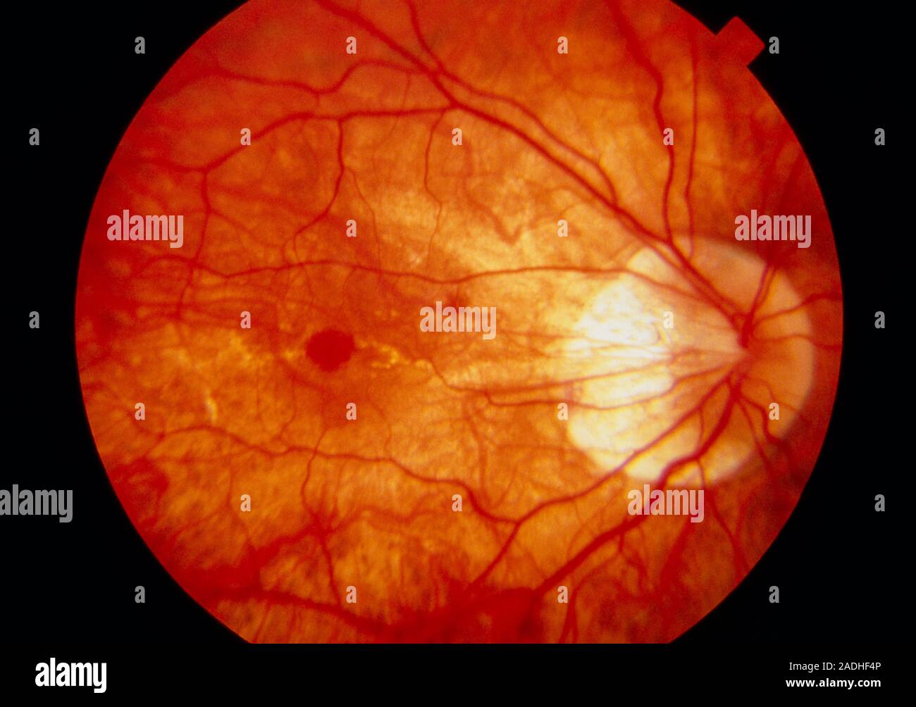 Cracked retina. Ophthalmoscope view of the eye of a patient with a cracked retina. The optic