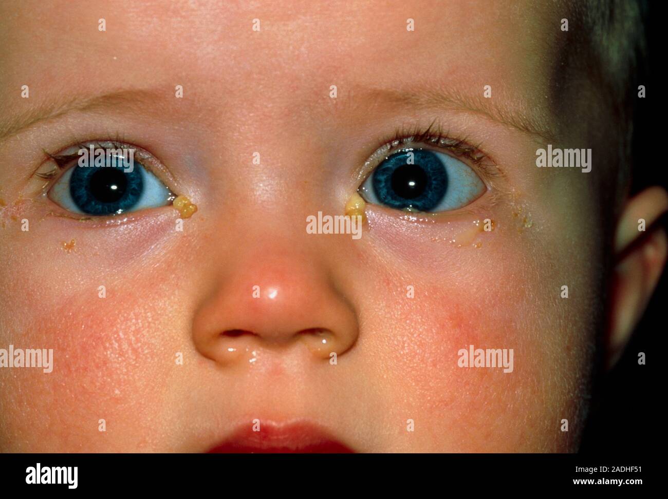 Acute conjunctivitis. Closeup of the eyes of a 1 yearold baby with