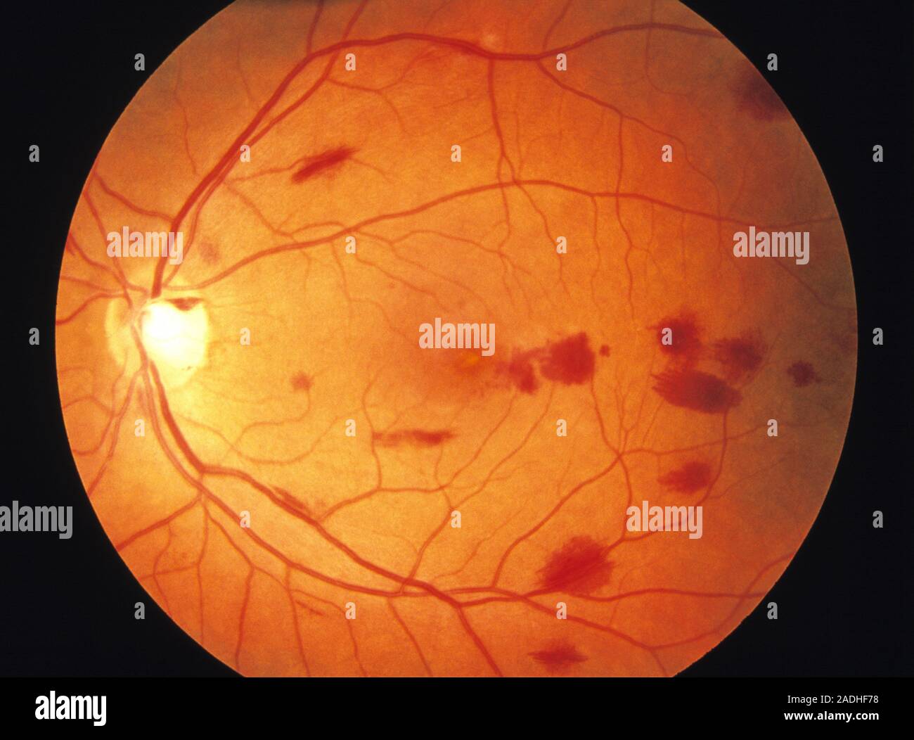 Retina damage. Ophthalmoscope image of retinopathy caused by chronic