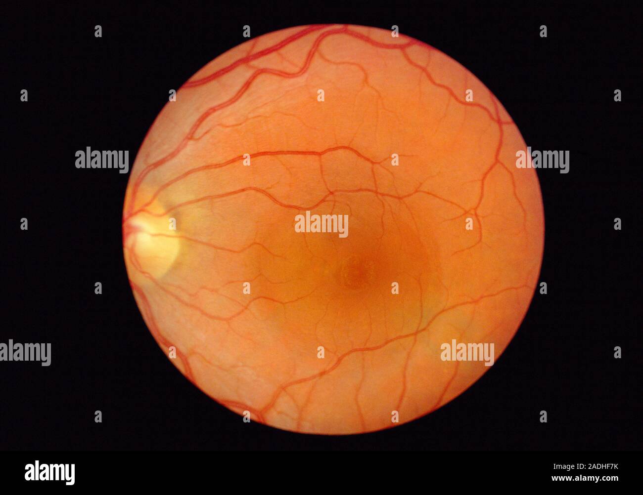 Retinal blood vessel disorder. Ophthalmoscope view of a retina showing