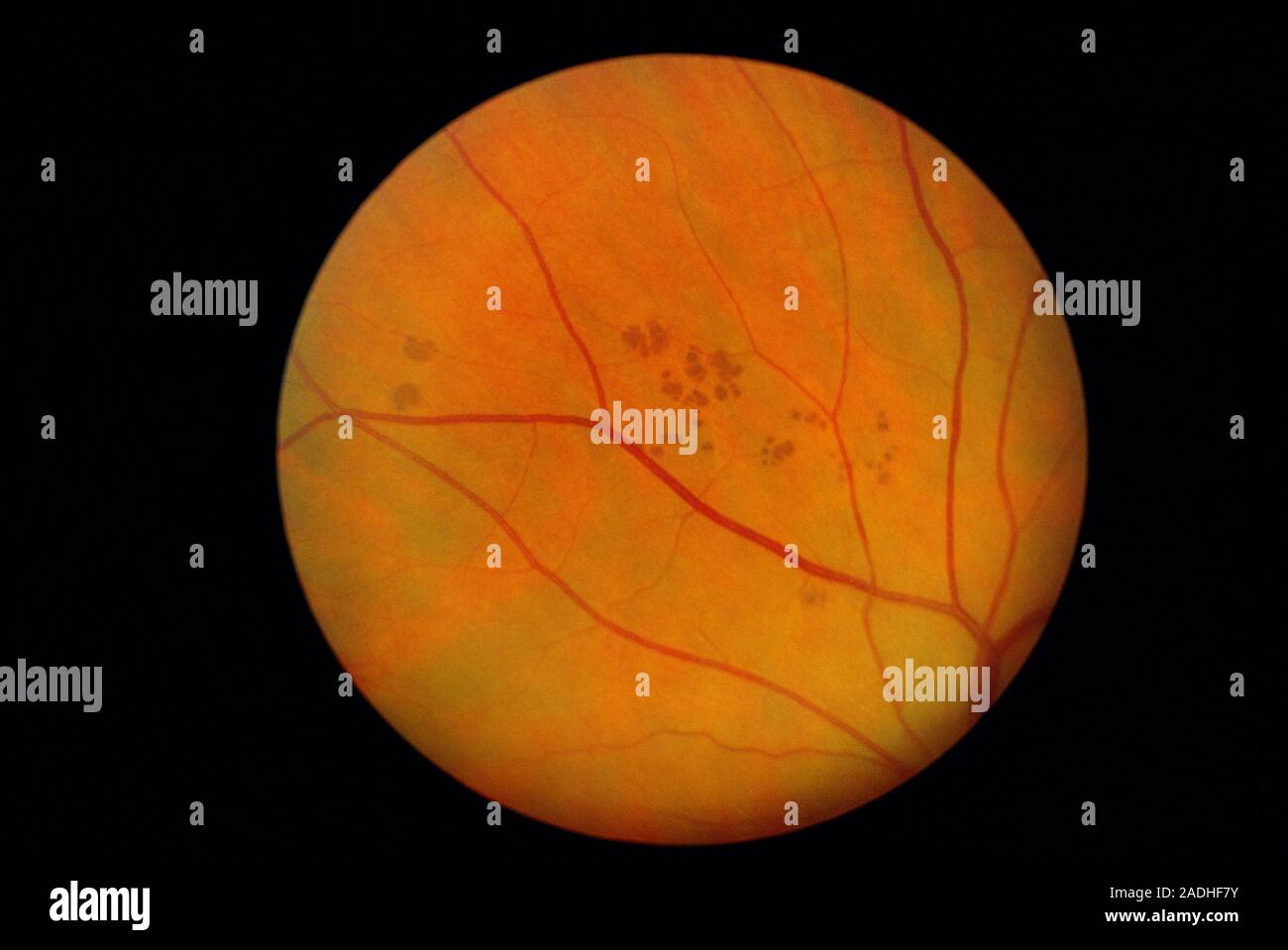 Bear Tracks On The Retina Of The Eye Ophthalmoscope Image The Bear 