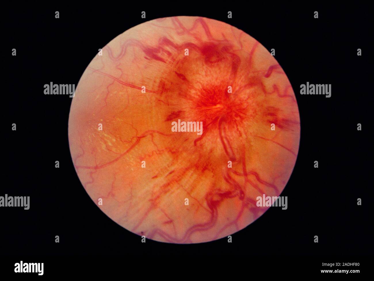 Papilloedema of the eye, ophthalmoscope image. Papilloedema is the congestion and swelling of