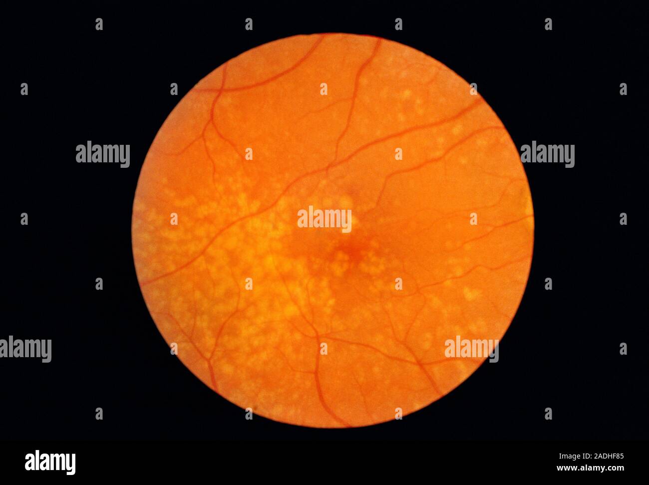 Macular degeneration, ophthalmoscope image. Numerous yellow drusen