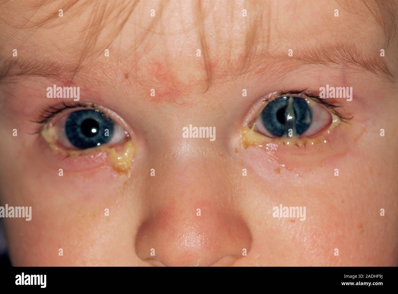Bacterial conjunctivitis. One yearold boy with pus around his red, swollen eyes. These