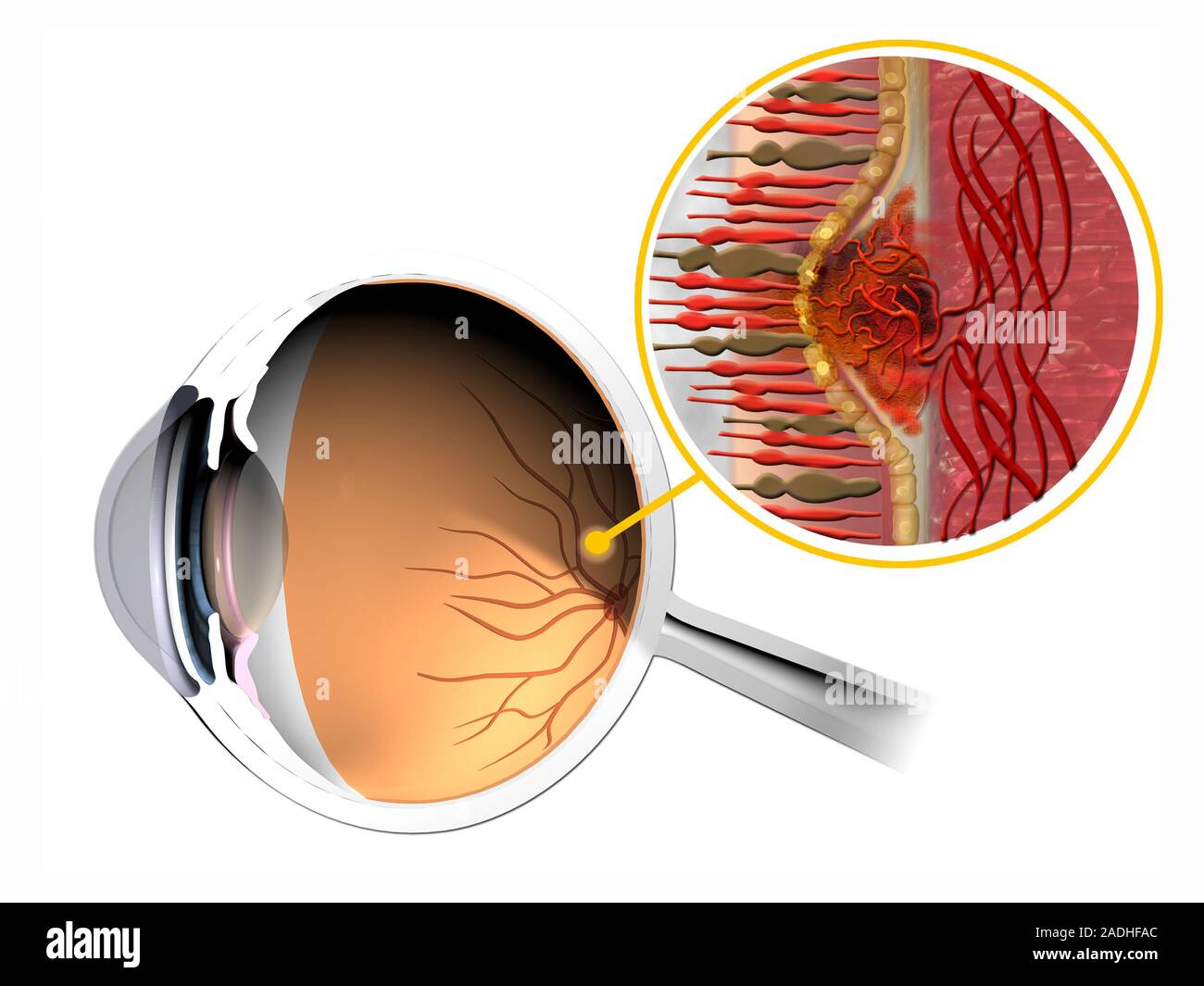 Macular degeneration. Computer artwork of an eye affected by wet agerelated macular