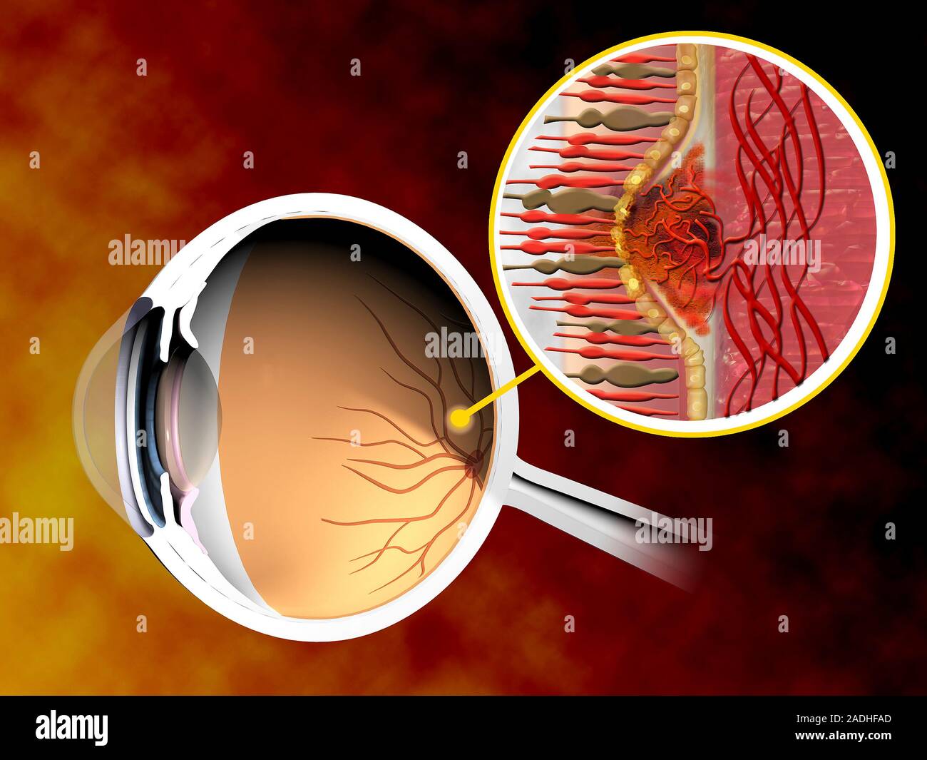 Macular degeneration. Computer artwork of an eye affected by wet age