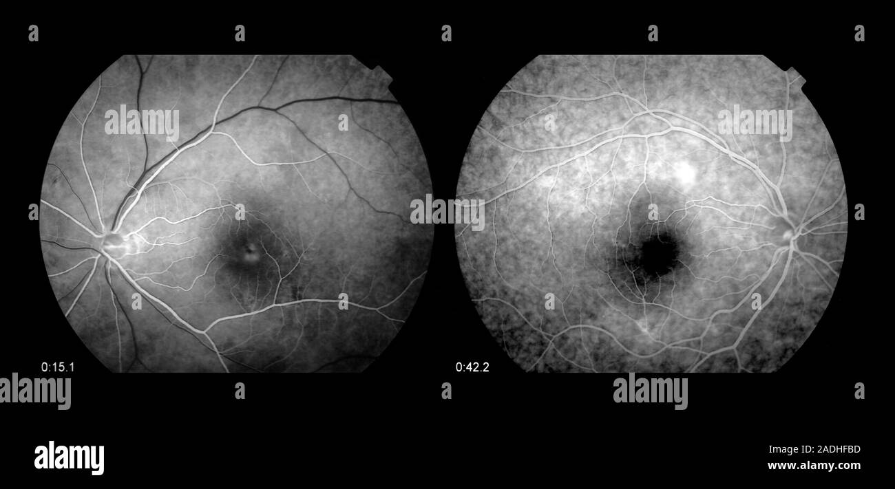 Irritated macula. Ophthalmoscope view of the retinas of a patient with
