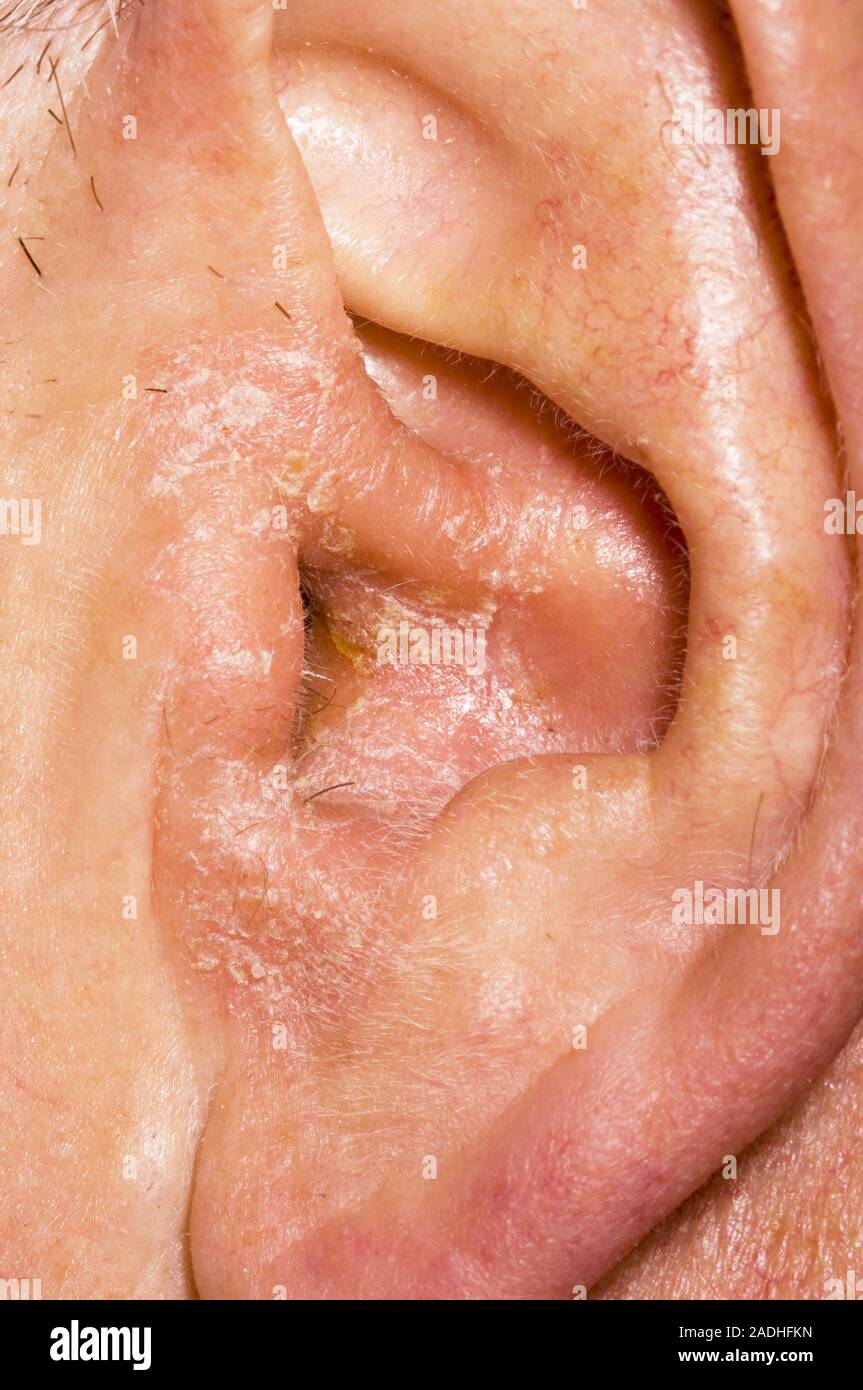 Outer ear infection (otitis externa) in a 67-year-old man. Otitis ...