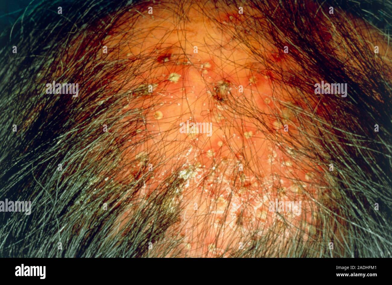 Example Of A Man Suffering With Folliculitis A Superficial Infection