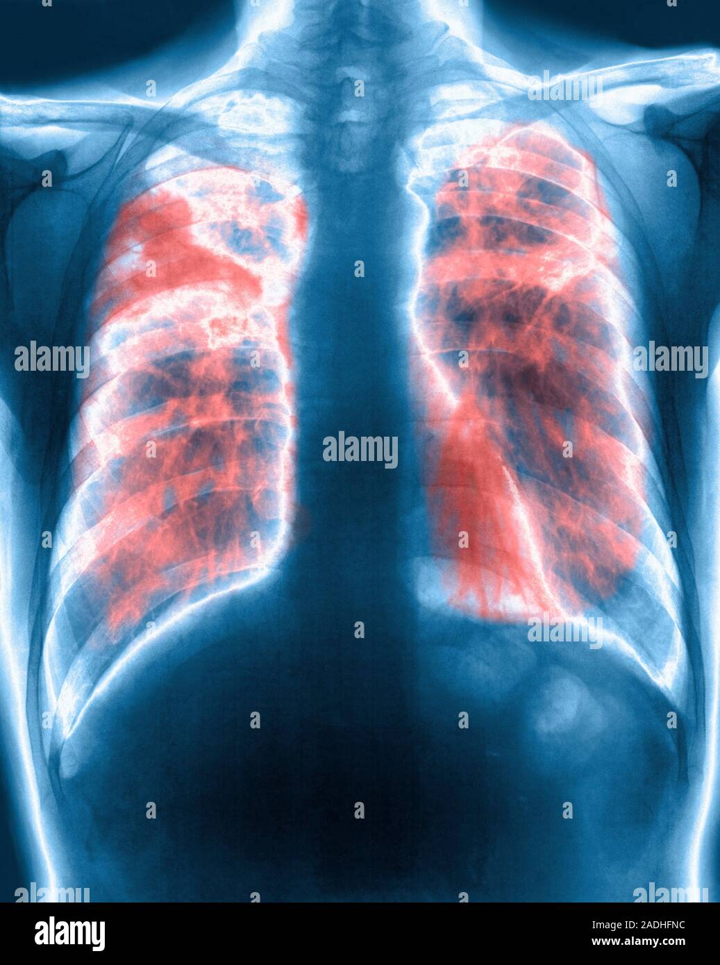 Lung fibrosis. Coloured Xray of the chest of a patient with pulmonary (lung) fibrosis, or