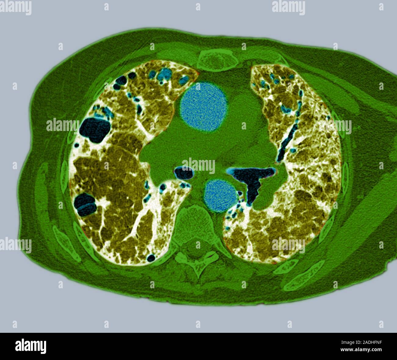 Lung fibrosis. Image 3 of 3. Coloured computed tomography (CT) scan through the chest of a
