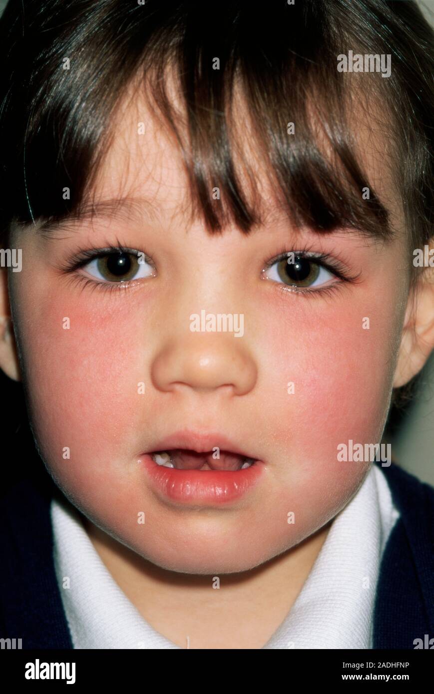 Fifth disease. Red rash on a fiveyearold girl's cheeks due to fifth