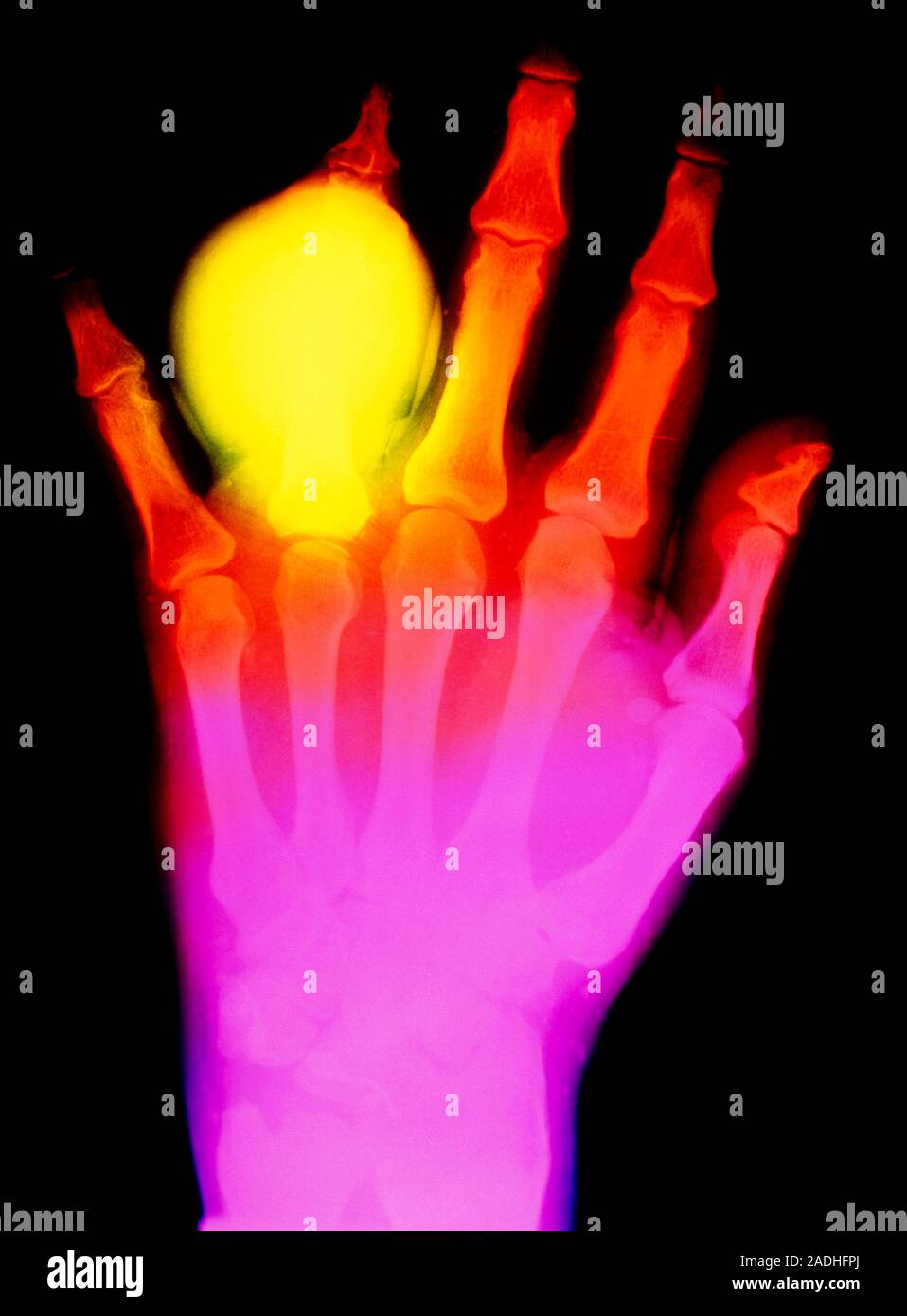 Falsecolour Xray of the left hand of a patient suffering from gouty