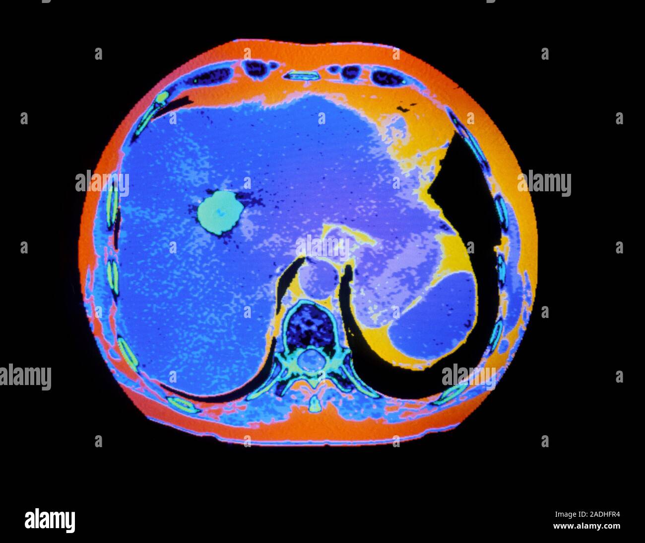 Gall stones. False-colour computed tomography (CT) scan of an axial ...