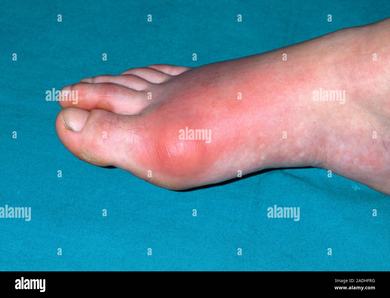 Gout. The foot of a patient with gout, showing an inflamed, reddened ...