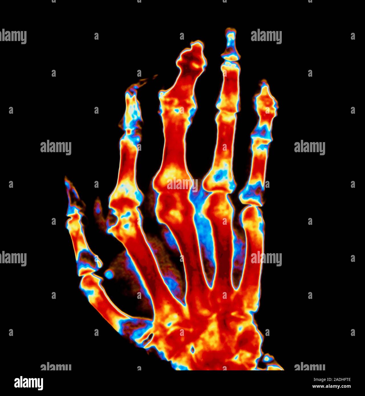 Gouty hand. Coloured Xray image of the hand of a patient suffering