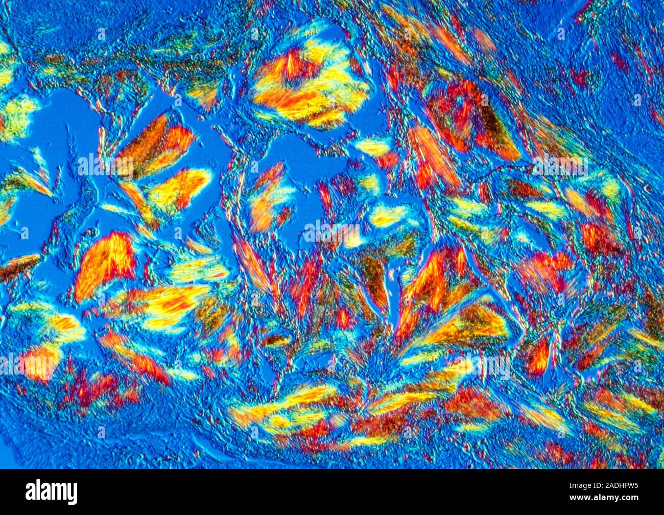 Crystals in gout. Light micrograph of uric acid crystals from a gouty
