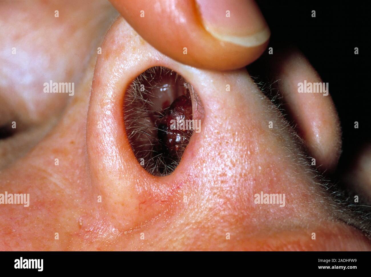 How to treat granuloma on nose piercing deals