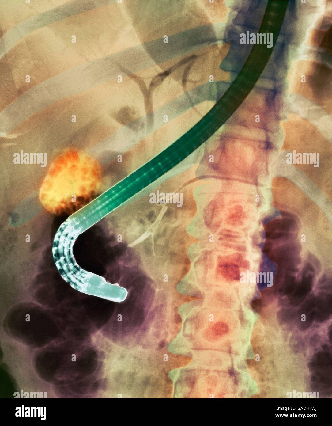 Gallstones. Coloured Xray of gallstones (orange) in a patient's gall