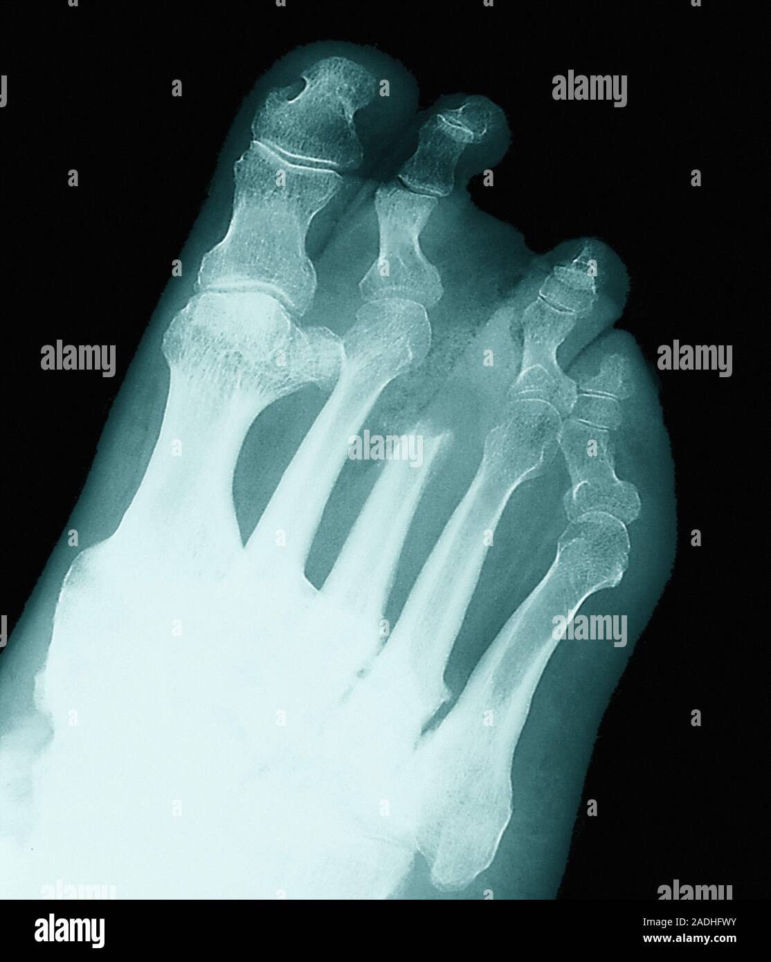 Gouty foot. X-ray image of a foot affected by gout (gouty arthritis ...