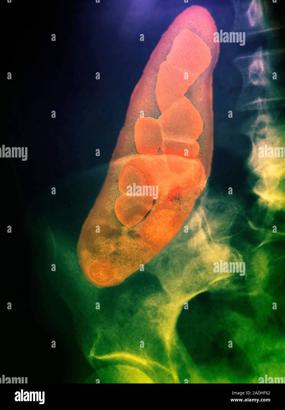 Porcelain gallbladder with gallstones, coloured X ray. This is a rare