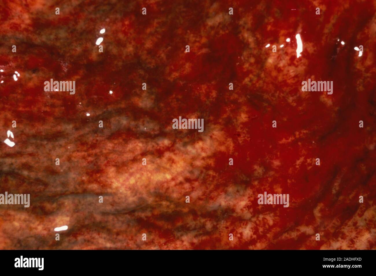 Erosive gastritis. Gross clinical specimen of tissue from a stomach in