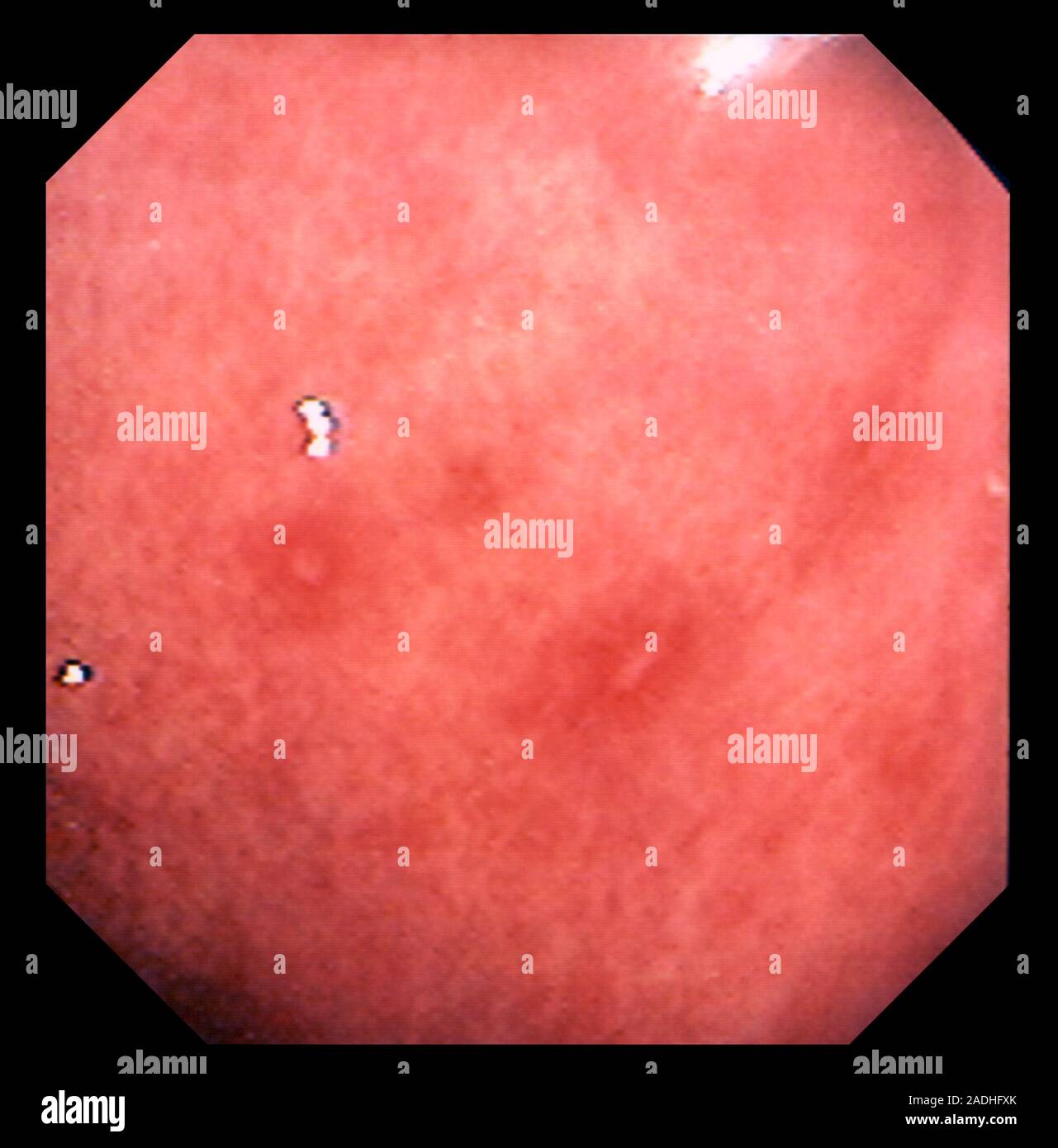 Erosive gastritis. Gastroscope (endoscope) view of the inflammed