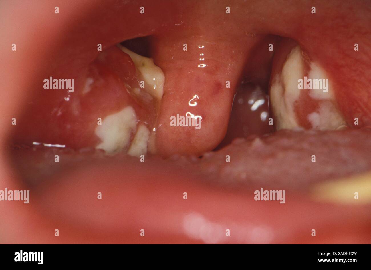 Tonsils In Glandular Fever Close Up Of Inflamed Pus covered Tonsils tonsils-in-glandular-fever-close-up-of-inflamed-pus-covered-tonsils