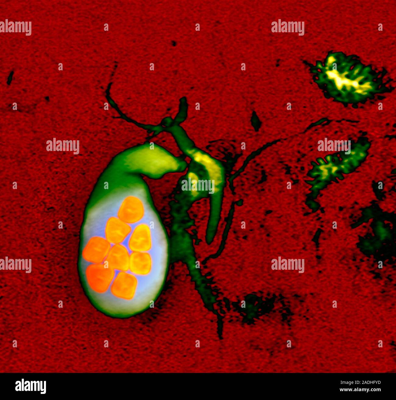Gallstones. Coloured MRI resonance imaging) scan of