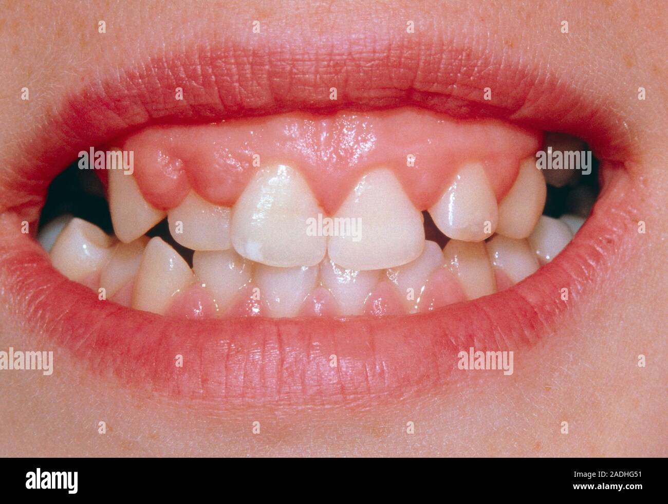 Hyperplasia of the upper gums, a consequence of long-term use of the drug phenytoin in treating epilepsy. Overactive growth of the gums is a recognise Stock Photo