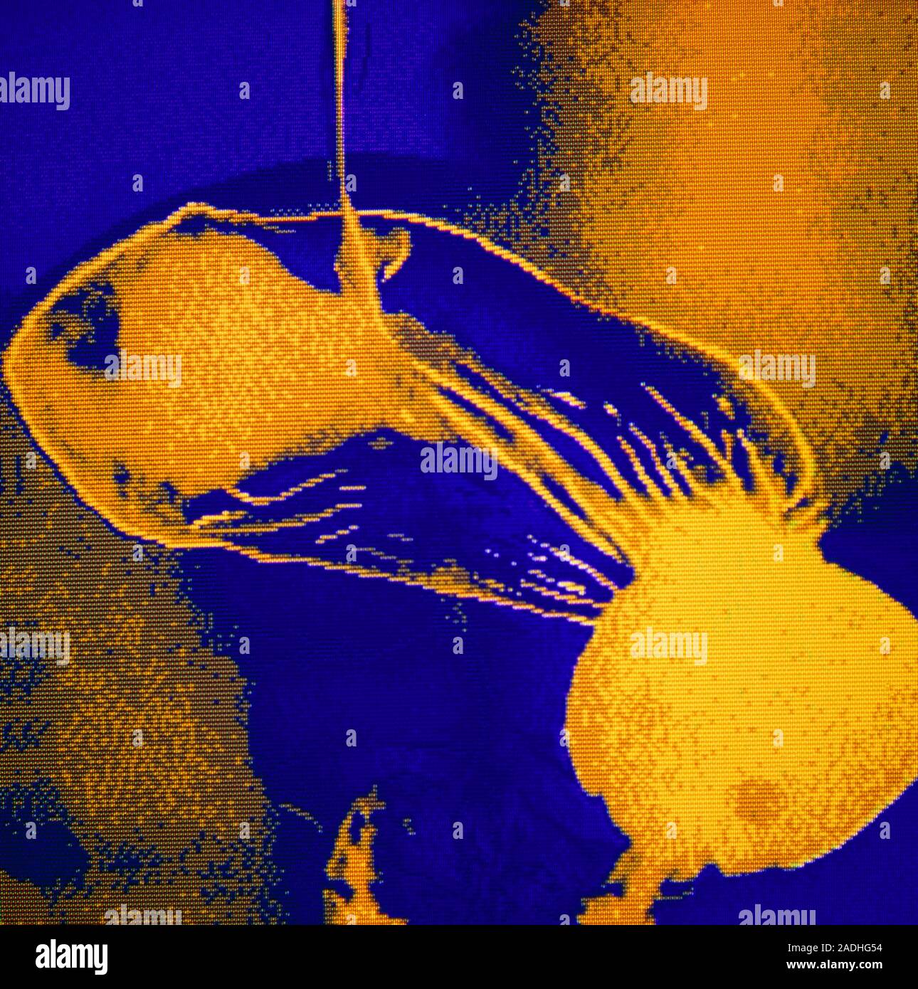 Hiatus hernia doublecontrast barium meal (Xray) of a person