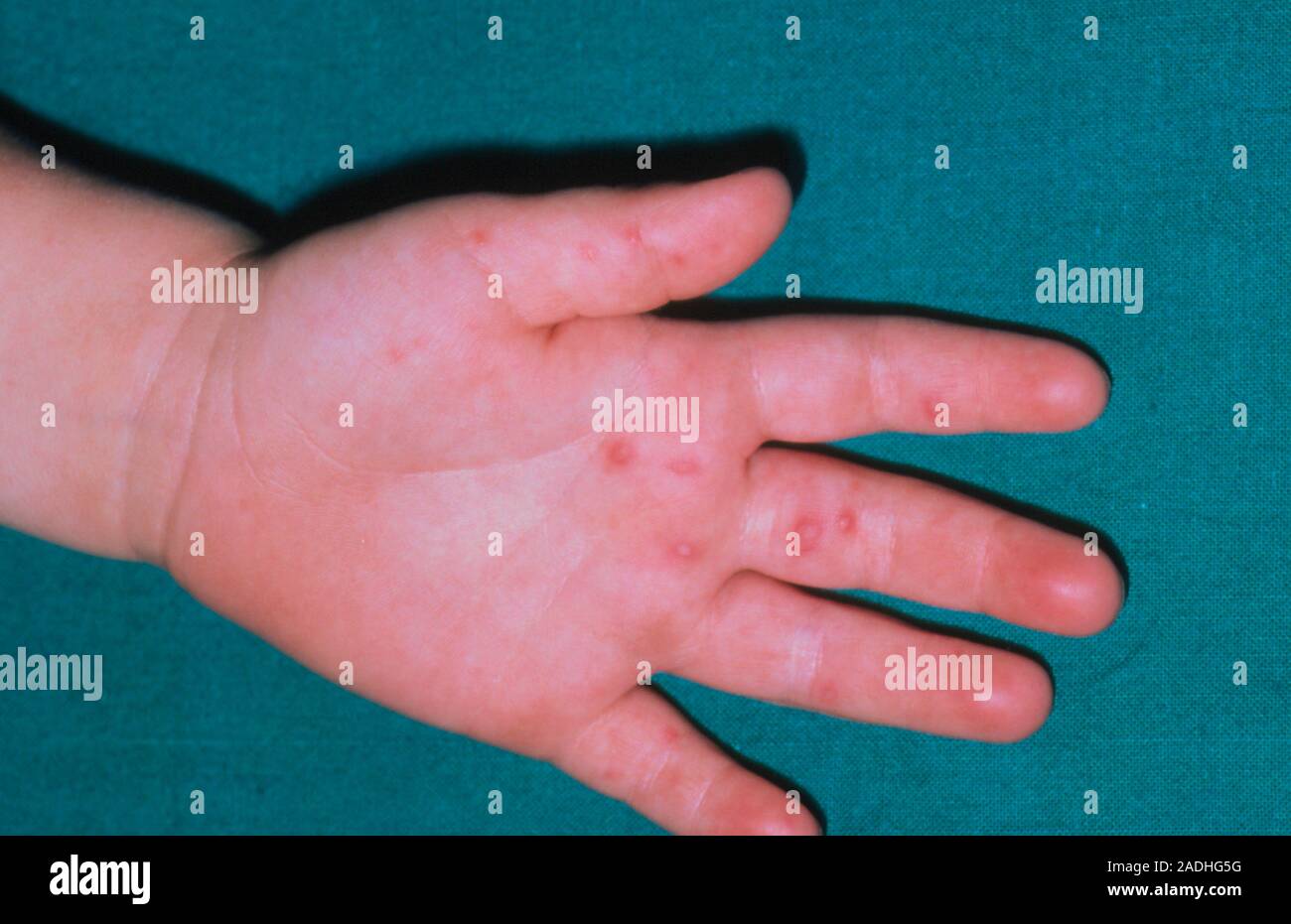 Skin lesions on a child's hand due to hand, foot and mouth disease (HFM