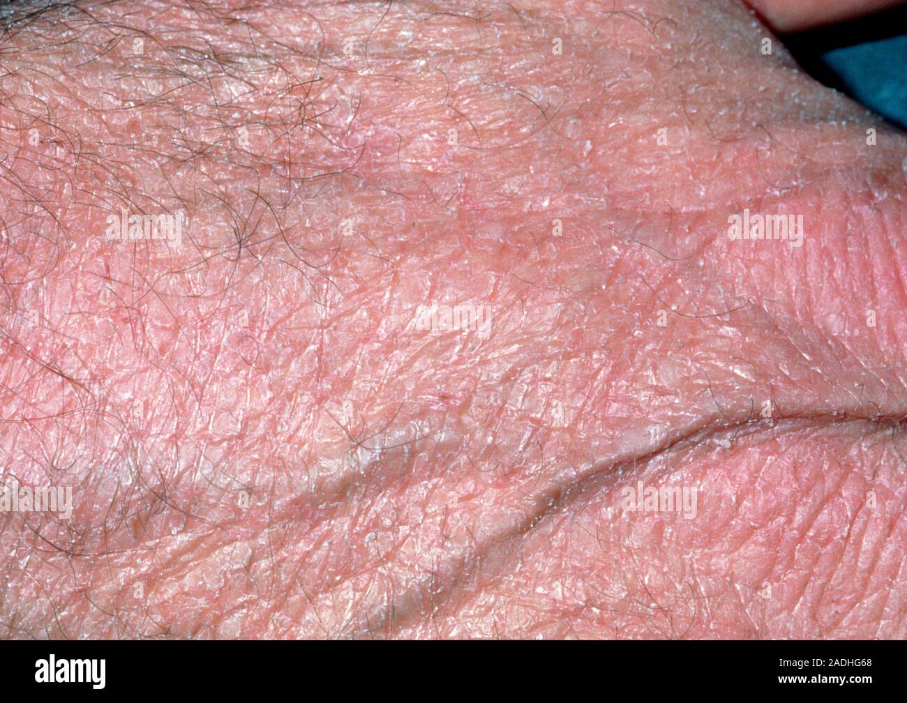 Hypothyroidism. Coarse, dry skin on the back of the hand of a patient  suffering from hypothyroid- ism. Hypothyroidism is caused by  under-production of Stock Photo - Alamy