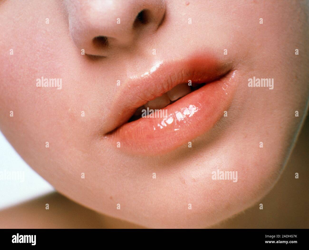 Cold sore. Woman's upper lip infected by the Herpes simplex virus (HSV