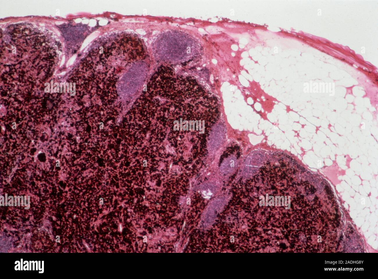 Excessive iron absorption. Light micrograph of a section through tissue ...