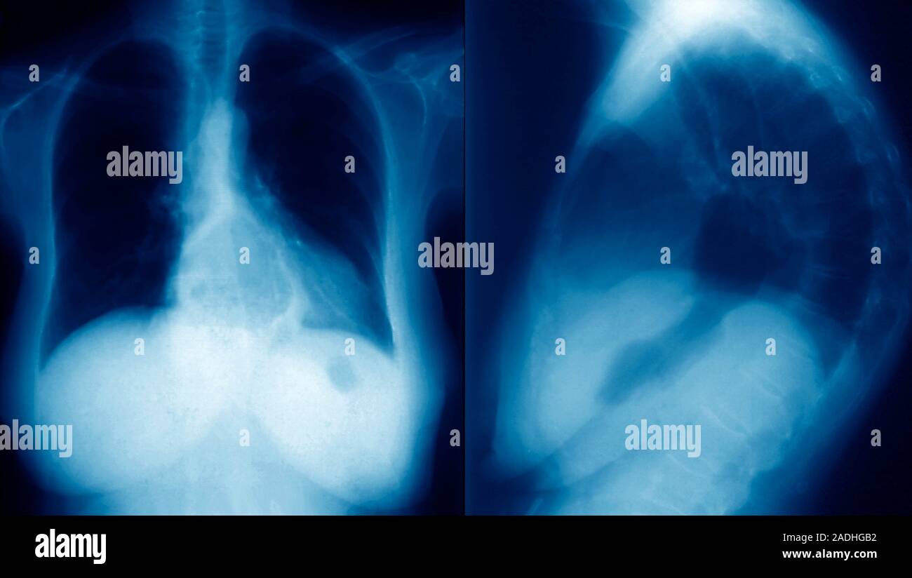 Hiatus hernia. Frontal (left) and sideview (right) Xrays of a patient