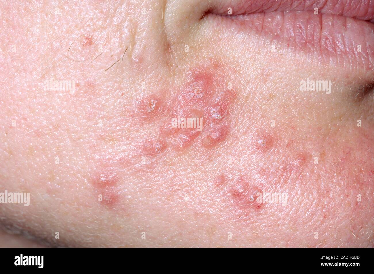 Cold sores on a 36 year old woman's chin. Cold sores are painful,  fluid-filled blisters caused by infection with the herpes simplex virus.  The infecti Stock Photo - Alamy