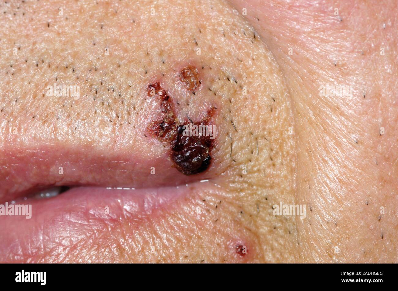 Cold Sores Around The Mouth Of An 80 Year Old Man Cold Sores Are